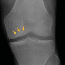 Condyle tibial fractures orthopaedicprinciples fracture