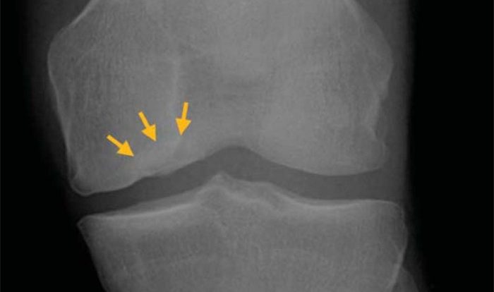 Condyle tibial fractures orthopaedicprinciples fracture