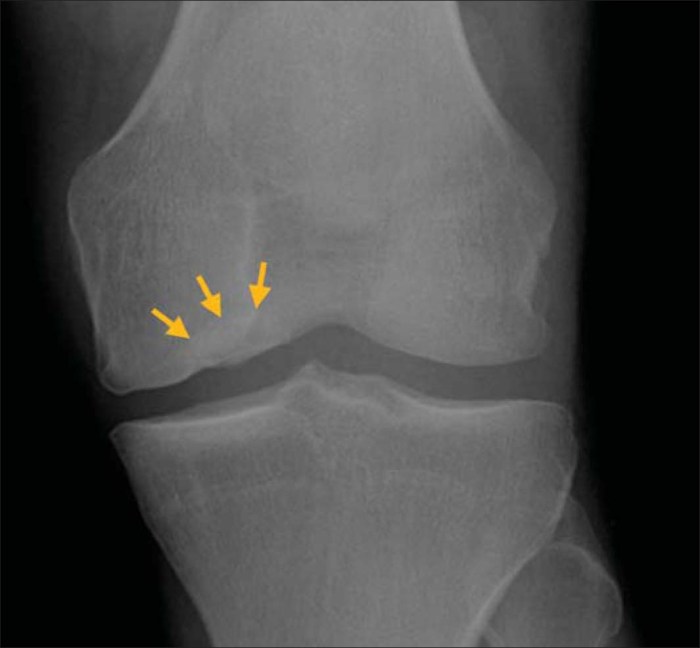 Condyle tibial fractures orthopaedicprinciples fracture