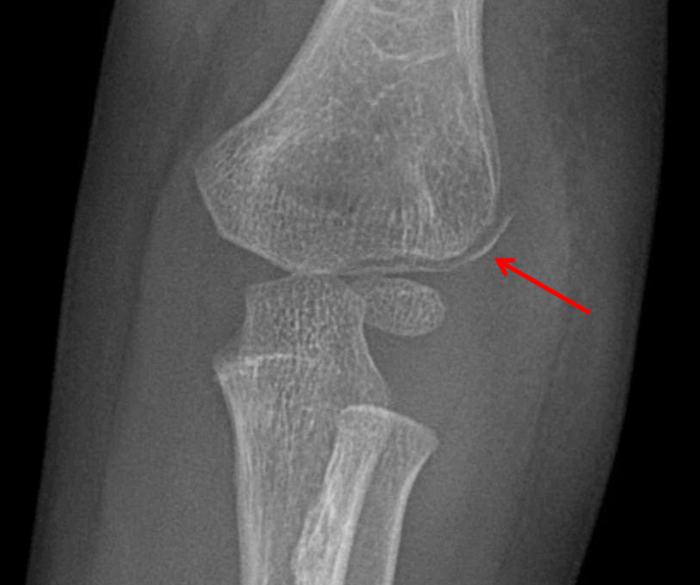 Condylar mandibular classification fractures figure