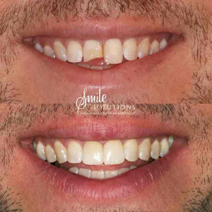 Which of the following statements is correct concerning porcelain veneers