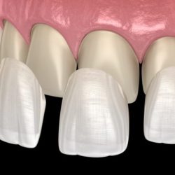 Which of the following statements is correct concerning porcelain veneers