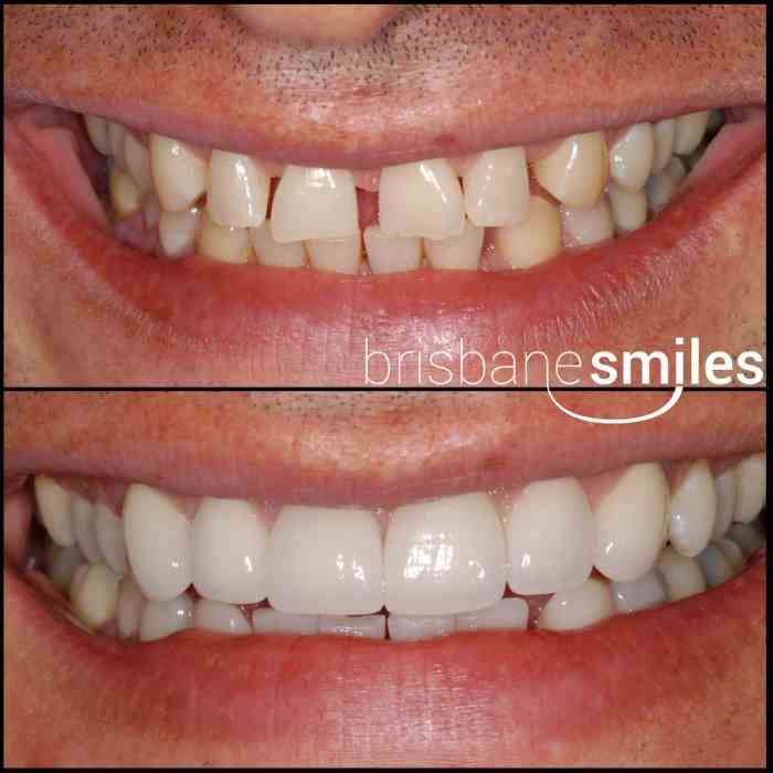 Veneers dental veneer cons teeth composite porcelain imperfections